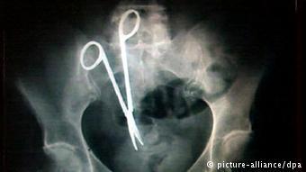 Одна из грубых врачебных ошибок - ножницы, забытые в брюшной полости пациента