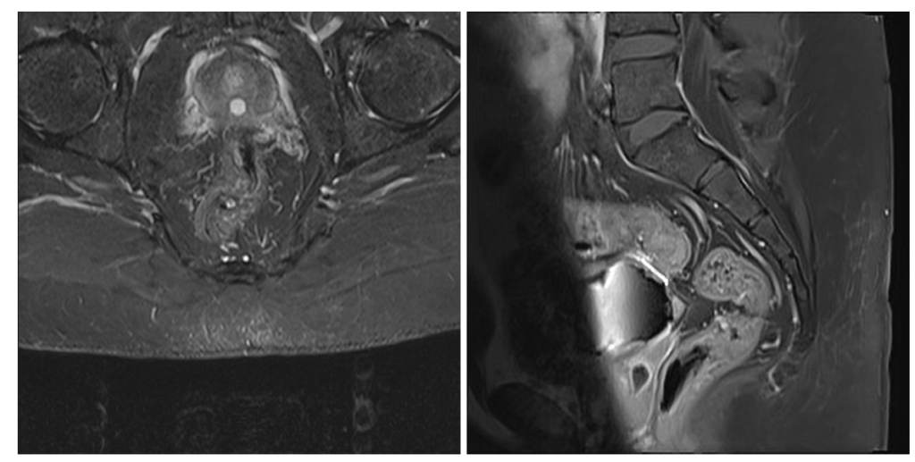 Киста простатической маточки на МРТ (слева режим STIR, справа Т1-ВИ с подавлением сигнала от жира). Визуализируется центрально расположенное объемное образование с ровными краями, с типичным гиперинтенсивным сигналом на STIR и гипоинтенсивным сигналом на Т1 ВИ