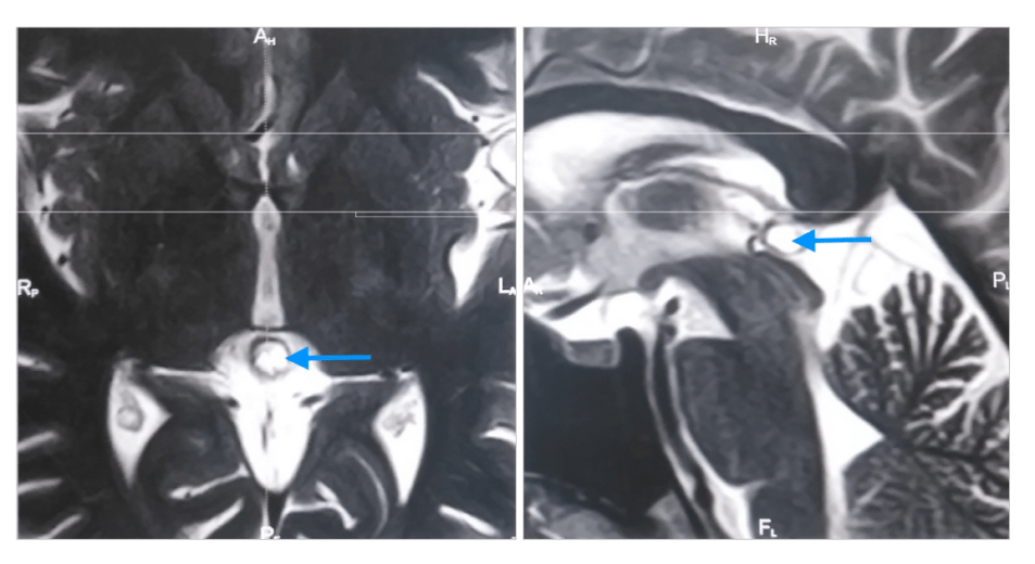 Киста шишковидной железы с типичным гиперинтенсивным сигналом на МРТ (Т2 ВИ) (отмечена синей стрелкой). Слева: аксиальная томограмма, справа – сагиттальная
