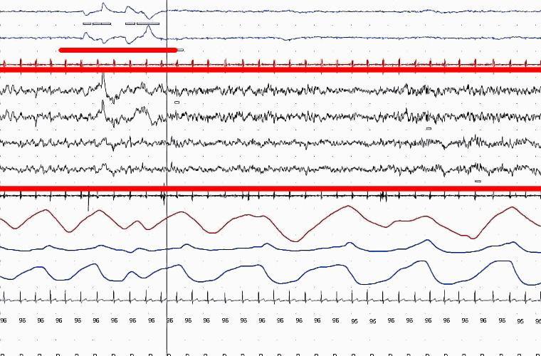 Электроэнцефалограмма и фаза быстрого сна (подчеркнута)