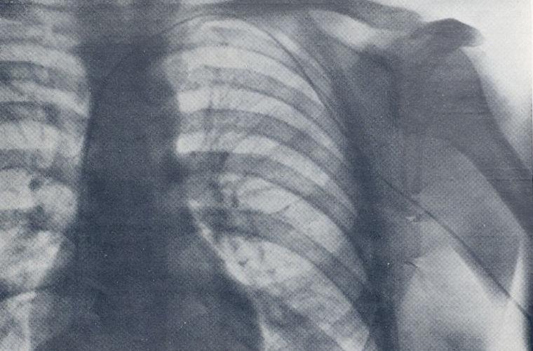 Рентген, на котором виден катетер, введенный доктором в свое тело