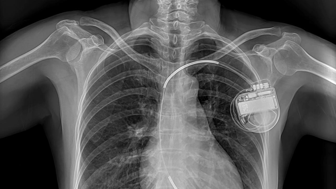 ИКД (имплантируемый кардиовертер-дефибриллятор) уменьшает опасность для жизни пациентов, у которых возможна внезапная остановка сердца, однако что мешало распространению одного из самых важных изобретений XX века?
