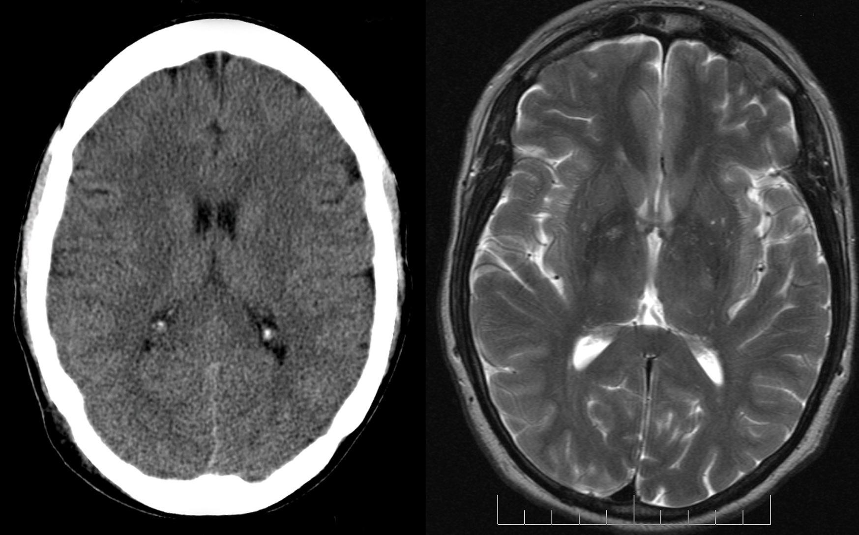 Слева компьютерная томограмма головного мозга, а справа- магнитно-резонансная. Легко заметить, насколько лучше различимы структуры мозга на МРТ.
