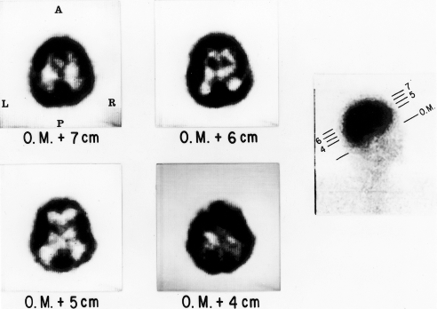 Первые изображения работы мозга, полученные на позитронно-эмиссионном томографе в августе 1976 года