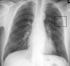 Рентгенография при раке легкого выявляет округлую тень слева. С целью дифференциальной диагностики (отличить рак легкого от туберкуломы, кисты или пневмонии) необходимо выполнять компьютерную томографию — КТ. 