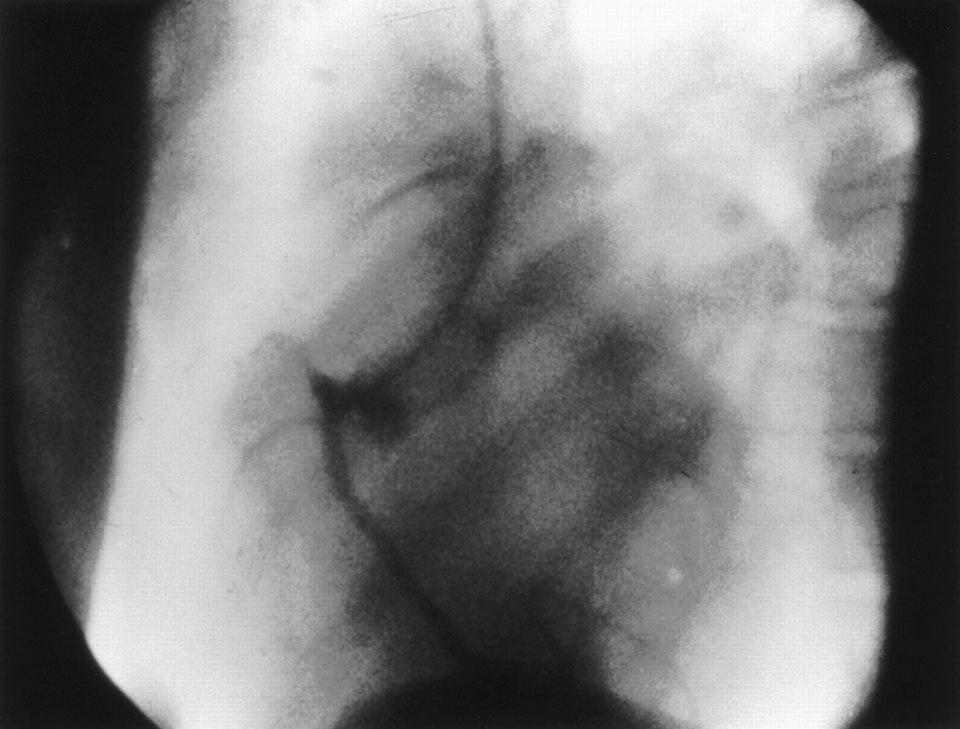 Кадр из исследования, сделанного Соунсом 30 октября 1958 года. Видна заполненная контрастом правая коронарная артерия. 