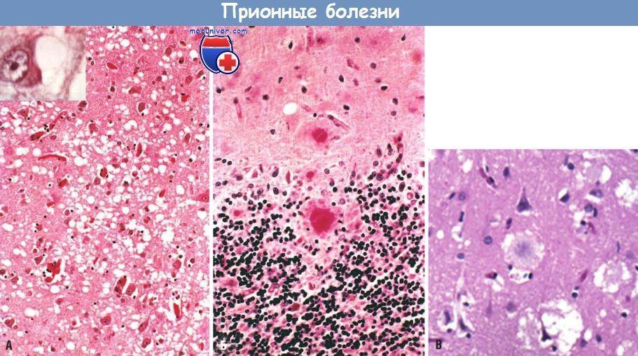 (А) Губкообразная дегенерация в коре больших полушарий. Врезка: нейроны, содержащие вакуоли. (Б) Кора мозжечка с бляшками куру (PAS-реакция), которые состоят из агрегатов PrPsc. ( В) Бляшки в корковом веществе, окруженные зоной губкообразной дегенерации, при новом варианте болезни Крейтцфельда-Якоба.